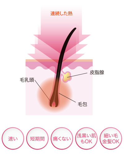 SHR脱毛のしくみ